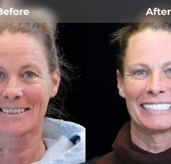 Dental Implants Before and After: Real Smile Transformations