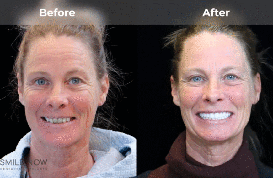 Dental Implants Before and After: Real Smile Transformations